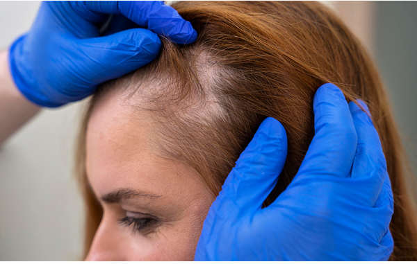 Close-up of thinning hair at the crown.